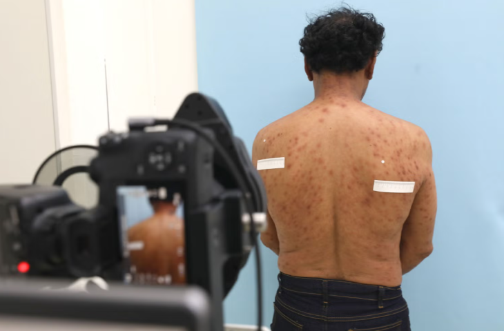 SES promove capacitação sobre talidomida para profissionais da saúde de MS