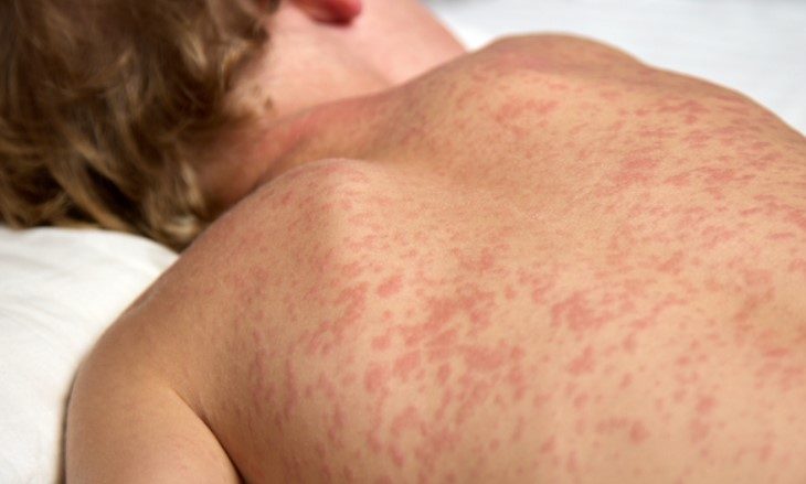 Governo qualifica profissionais de saúde e intensifica vacinação para barrar avanço do sarampo em MS