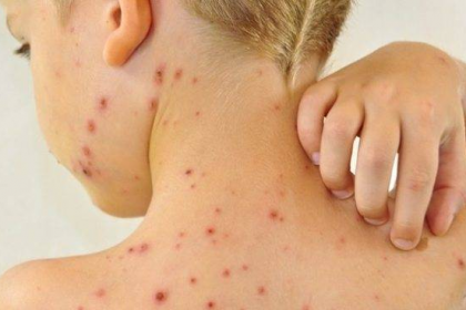 Surto na Bolívia acende alerta e Três Lagoas inicia “dose zero” do sarampo