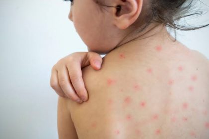 Dia D de vacinação contra o Sarampo será realizado neste sábado (30), em cinco USFs das 8h às 12h